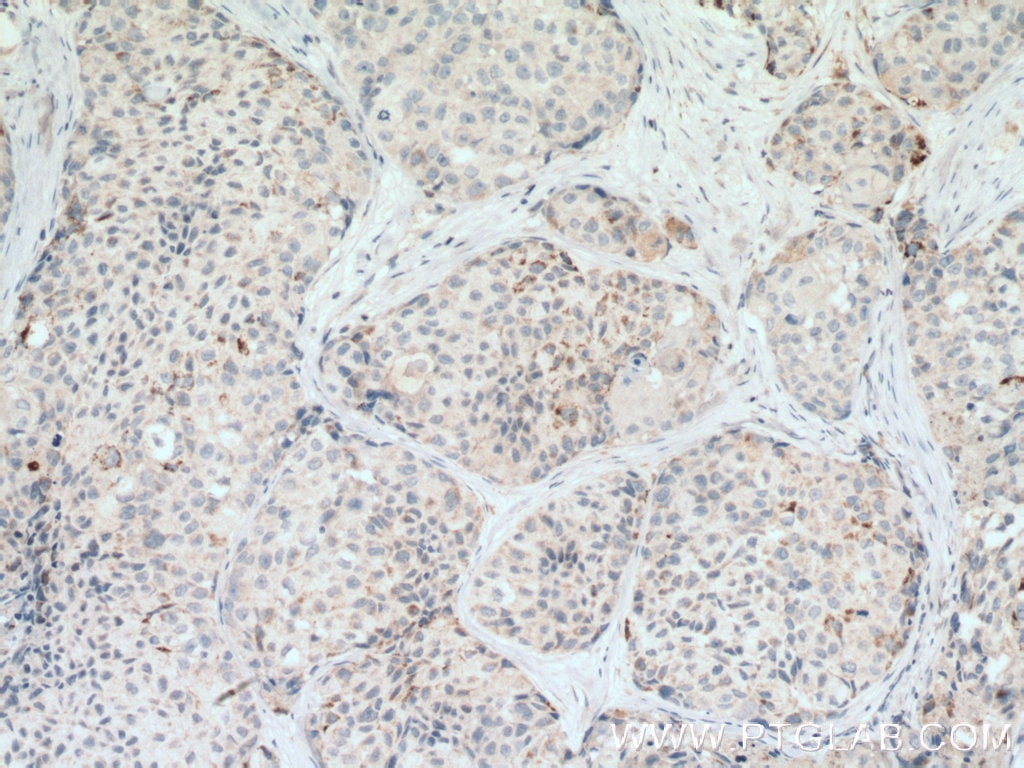 Immunohistochemistry (IHC) staining of human lung cancer tissue using RARRES3 Polyclonal antibody (12065-1-AP)