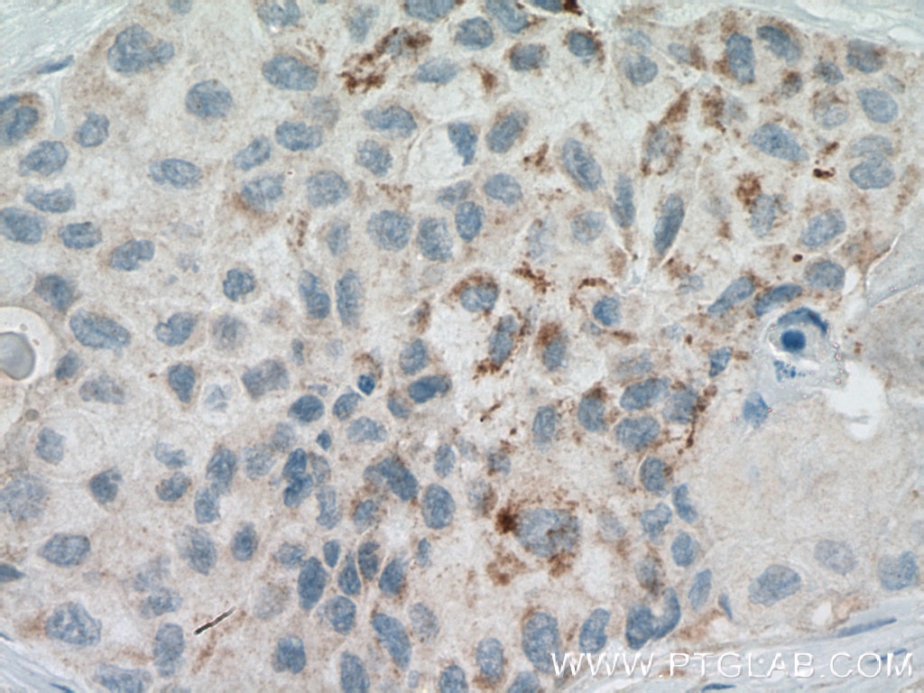 Immunohistochemistry (IHC) staining of human lung cancer tissue using RARRES3 Polyclonal antibody (12065-1-AP)