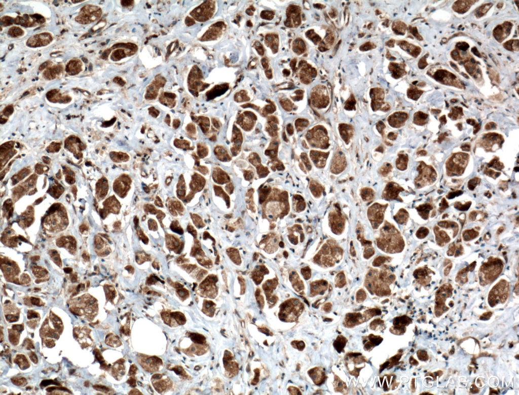 Immunohistochemistry (IHC) staining of human breast cancer tissue using RARS Polyclonal antibody (27344-1-AP)