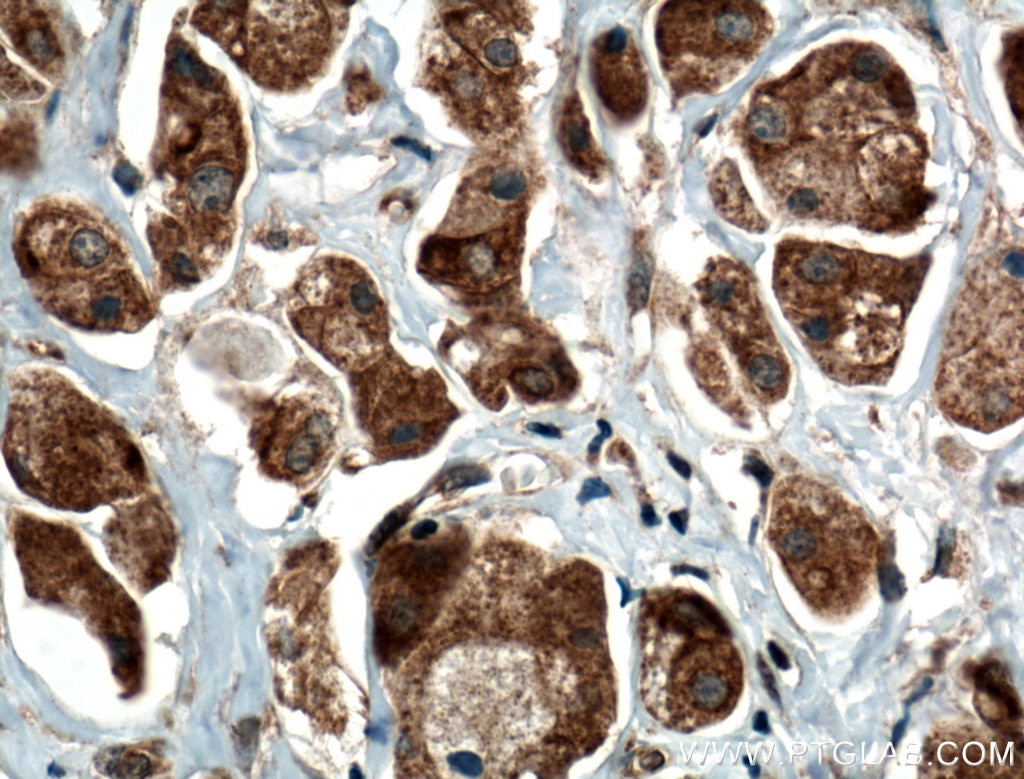 Immunohistochemistry (IHC) staining of human breast cancer tissue using RARS Polyclonal antibody (27344-1-AP)