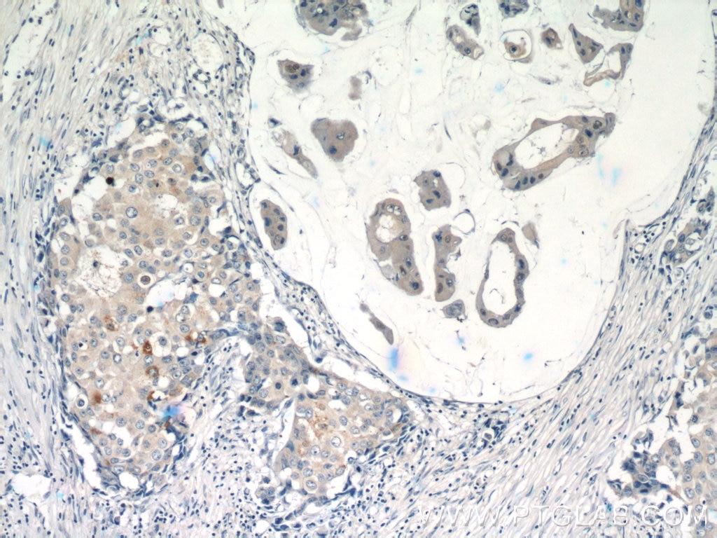 Immunohistochemistry (IHC) staining of human breast cancer tissue using RASGAP Polyclonal antibody (12935-1-AP)