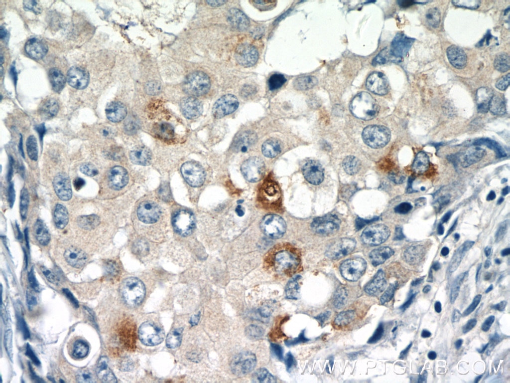 Immunohistochemistry (IHC) staining of human breast cancer tissue using RASGAP Polyclonal antibody (12935-1-AP)
