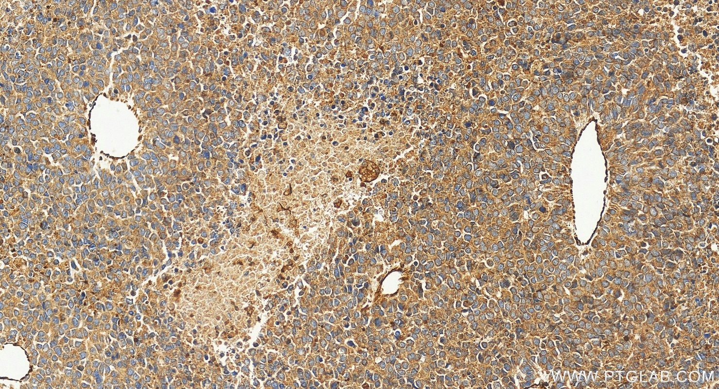 IHC staining of human Hepatocellular carcinoma using 31586-1-AP Immunohistochemistry (IHC) staining of human Hepatocellular carcinoma using RASA2 Polyclonal antibody (31586-1-AP)