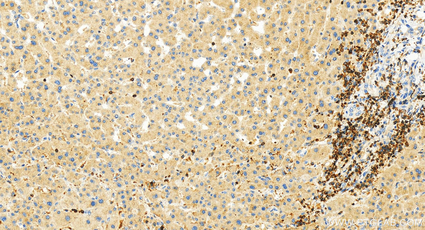 Immunohistochemistry (IHC) staining of human intrahepatic cholangiocarcinoma tissue using RASAL3 Polyclonal antibody (21164-1-AP)