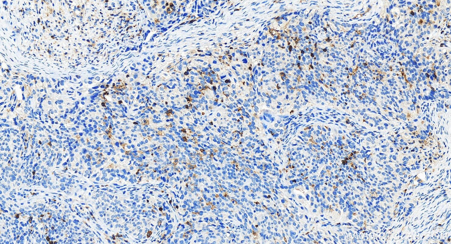 Immunohistochemistry (IHC) staining of human ovary cancer tissue using RASAL3 Polyclonal antibody (21164-1-AP)