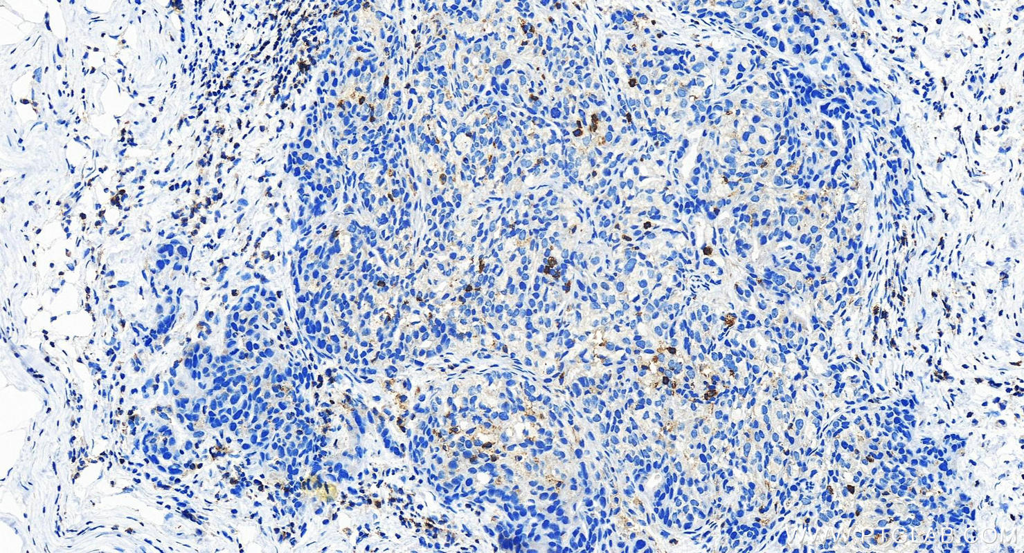 Immunohistochemistry (IHC) staining of human ovary cancer tissue using RASAL3 Polyclonal antibody (21164-1-AP)