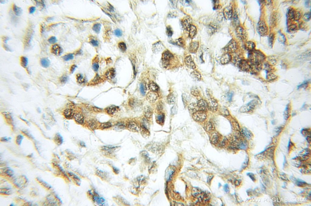 Immunohistochemistry (IHC) staining of human pancreas cancer tissue using RASEF Polyclonal antibody (11569-1-AP)