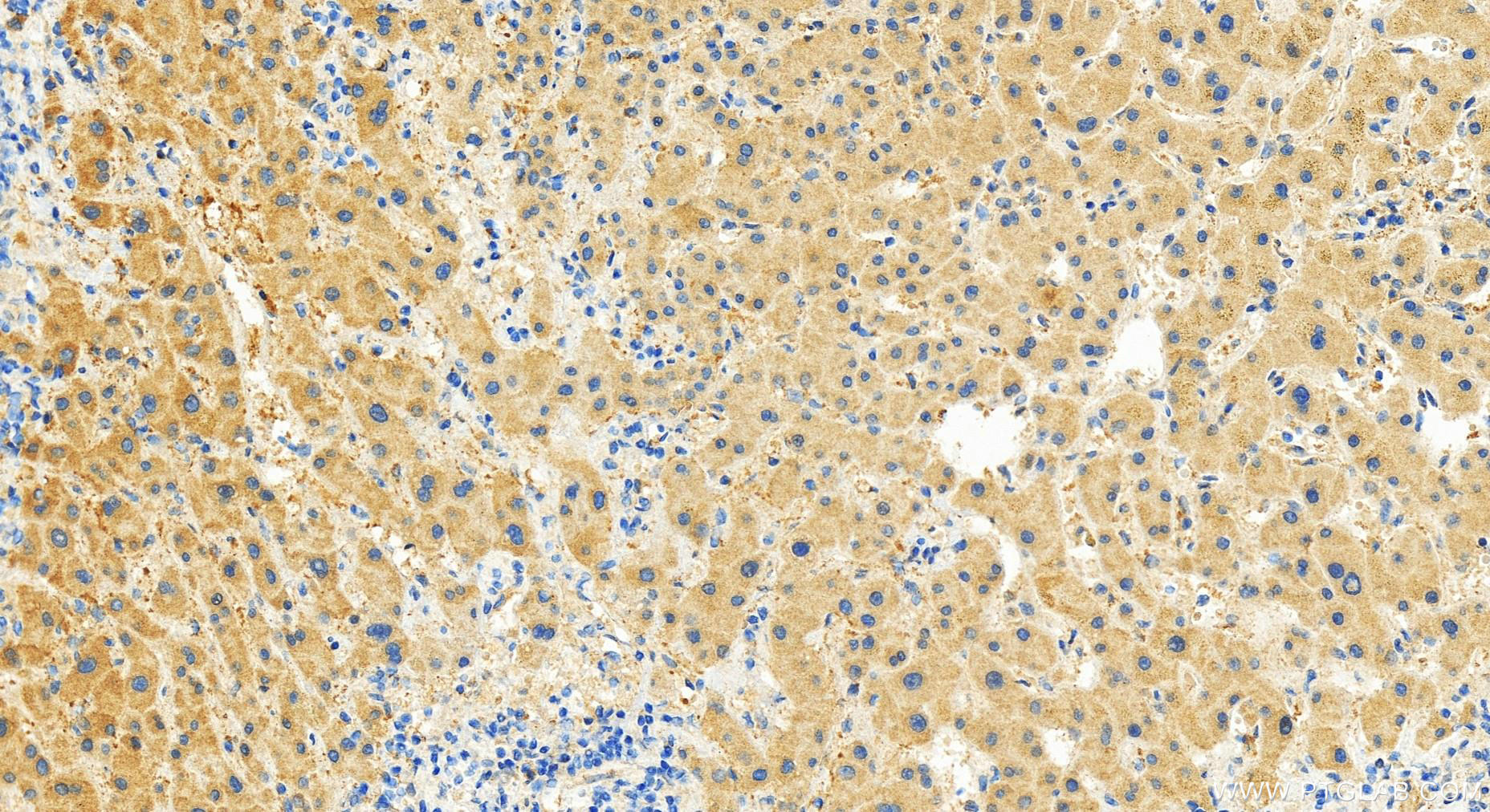 Immunohistochemistry (IHC) staining of human intrahepatic cholangiocarcinoma tissue using RASEF Polyclonal antibody (28162-1-AP)