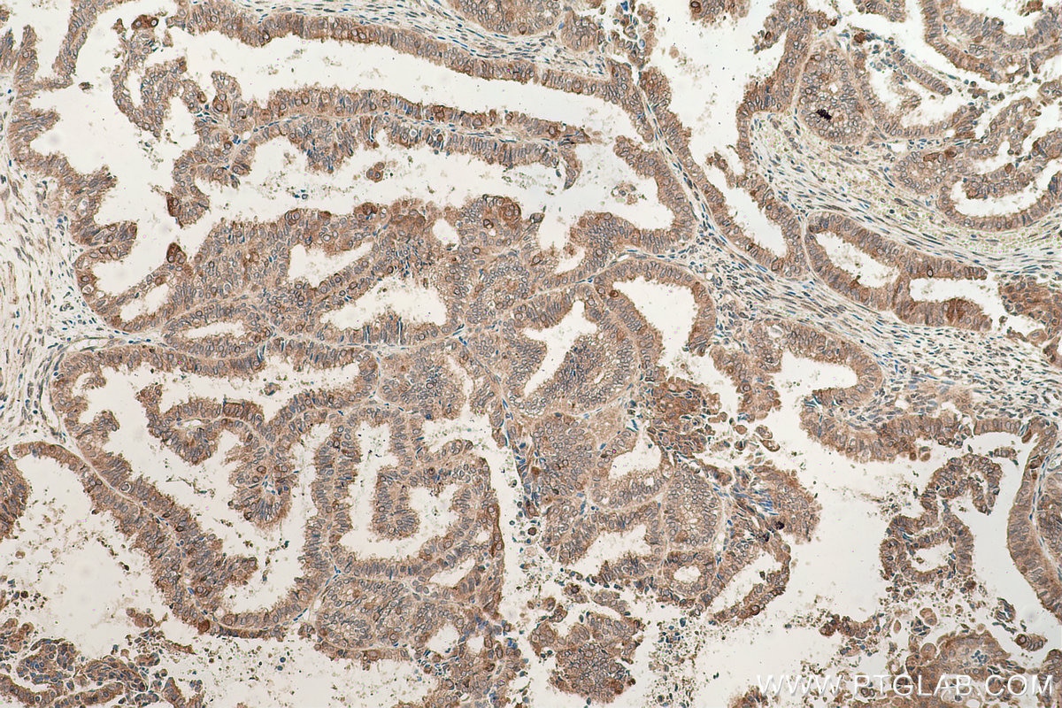 Immunohistochemistry (IHC) staining of human ovary tumor tissue using RASEF Monoclonal antibody (67159-1-Ig)