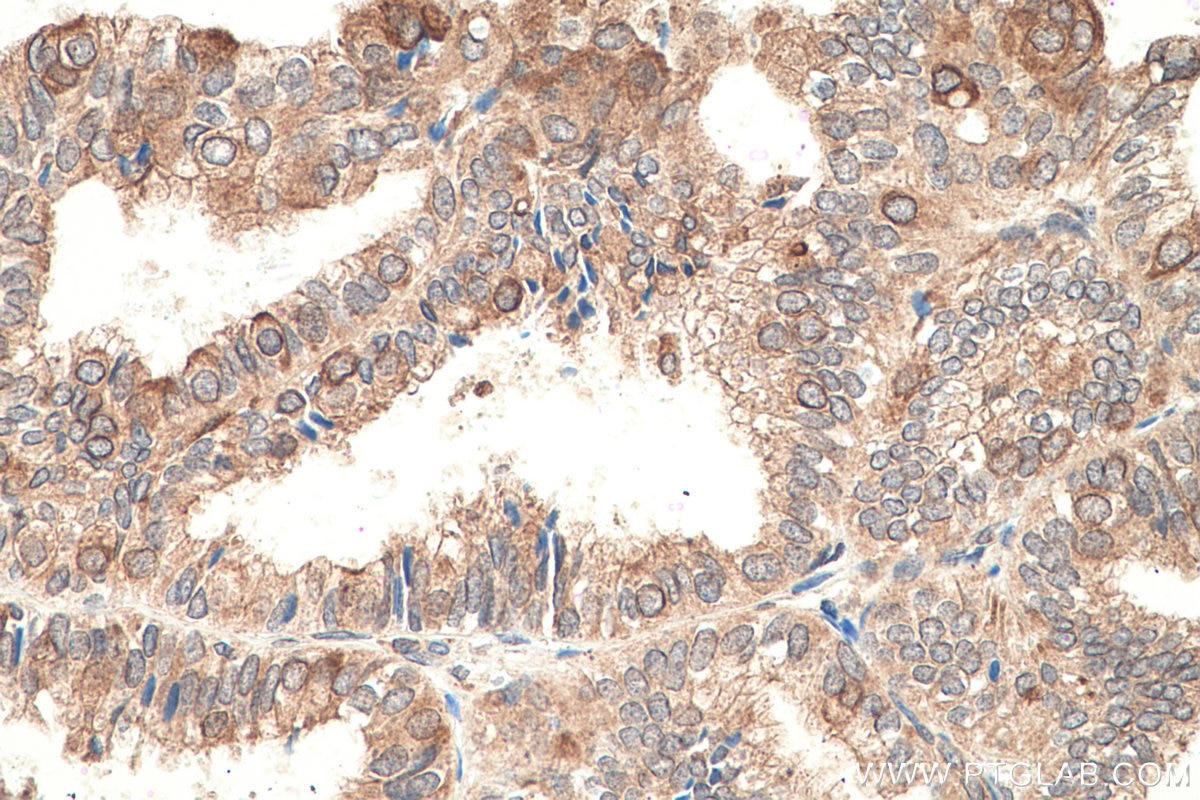 Immunohistochemistry (IHC) staining of human ovary tumor tissue using RASEF Monoclonal antibody (67159-1-Ig)