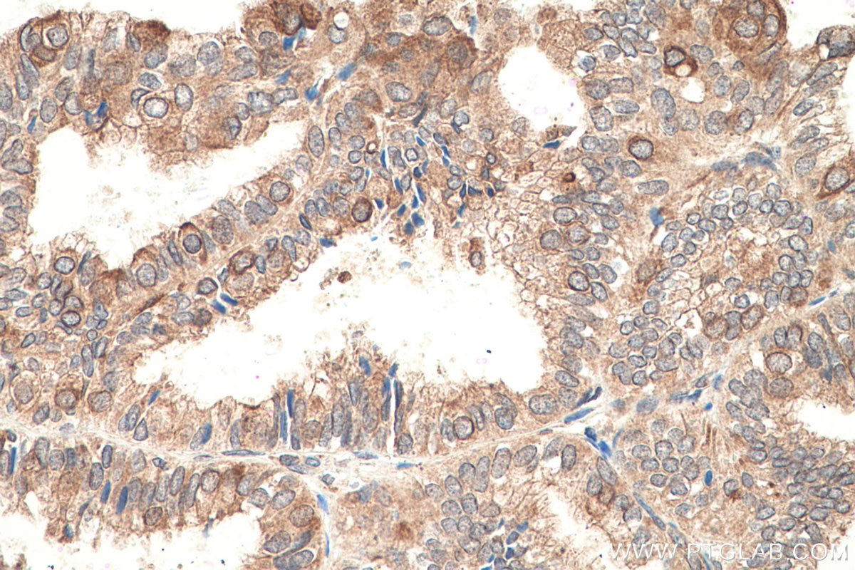 IHC staining of human ovary tumor using 67159-1-Ig