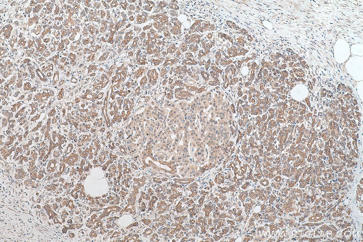 Immunohistochemistry (IHC) staining of human pancreas cancer tissue using RASEF Monoclonal antibody (67159-1-Ig)
