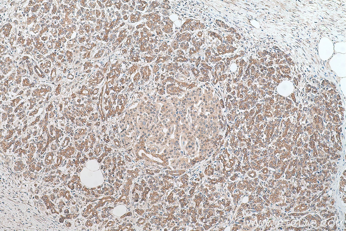 Immunohistochemistry (IHC) staining of human pancreas cancer tissue using RASEF Monoclonal antibody (67159-1-Ig)