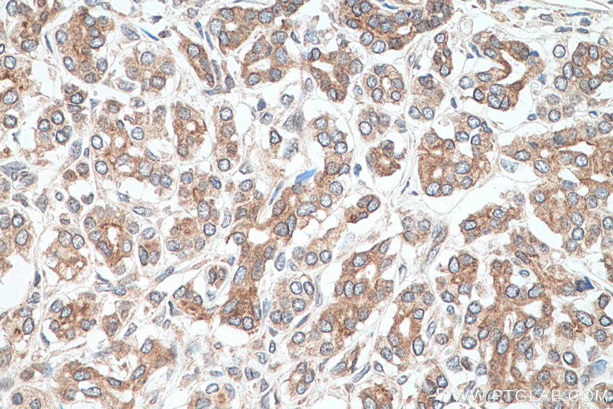 Immunohistochemistry (IHC) staining of human pancreas cancer tissue using RASEF Monoclonal antibody (67159-1-Ig)