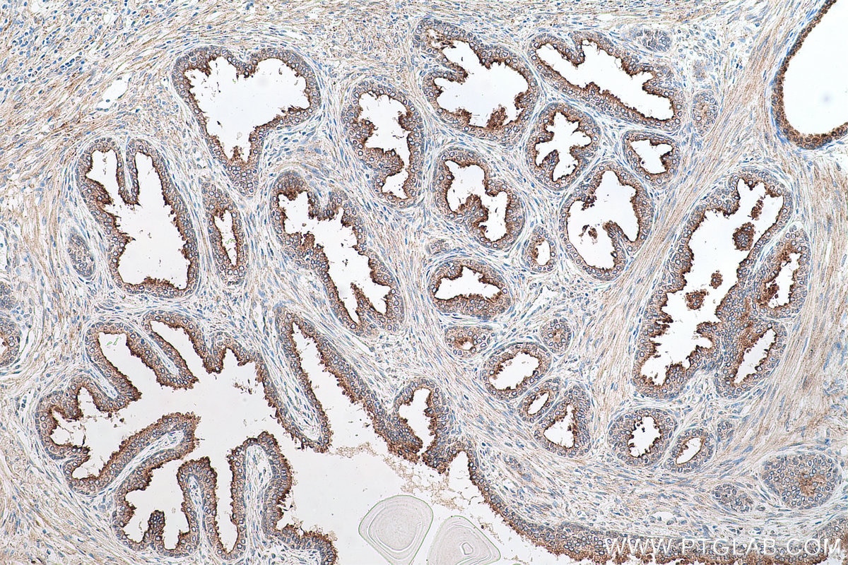 Immunohistochemistry (IHC) staining of human prostate cancer tissue using RASEF Monoclonal antibody (67159-1-Ig)