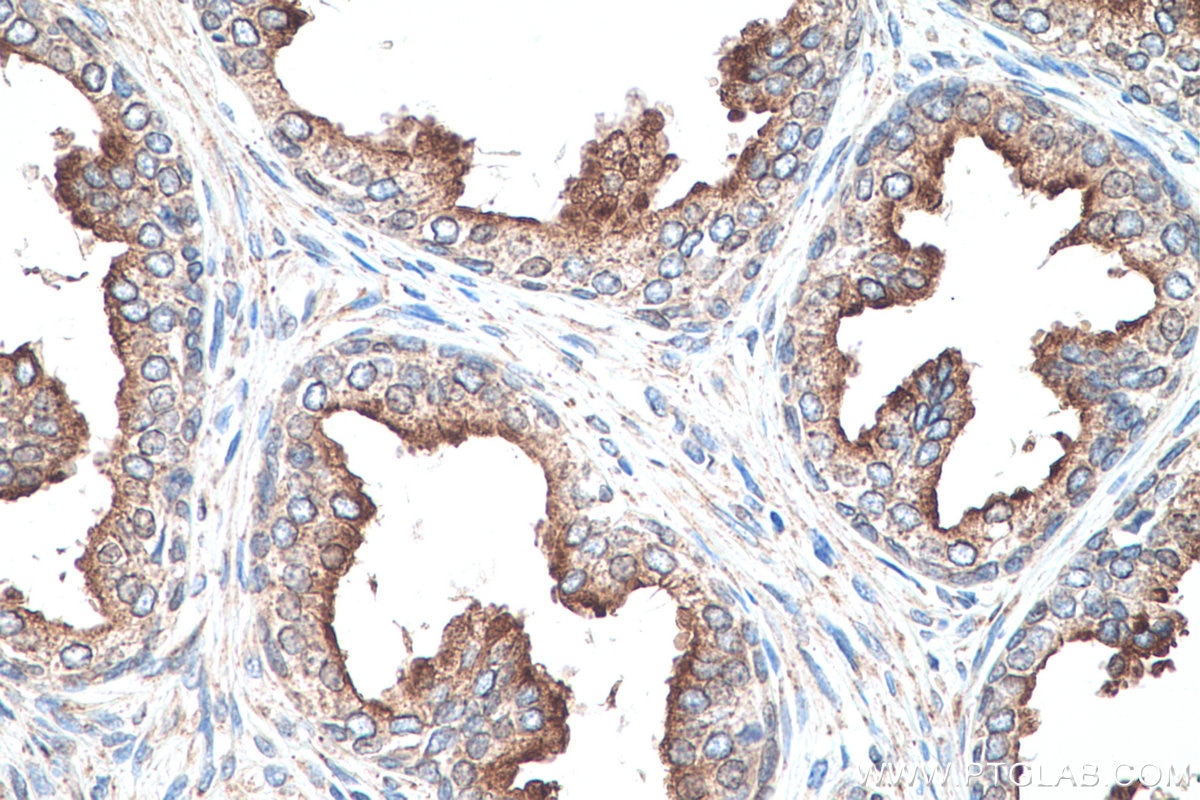 Immunohistochemistry (IHC) staining of human prostate cancer tissue using RASEF Monoclonal antibody (67159-1-Ig)