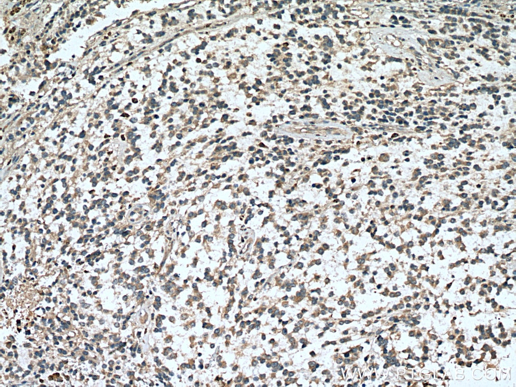 Immunohistochemistry (IHC) staining of human gliomas tissue using RASGEF1A Polyclonal antibody (17121-1-AP)