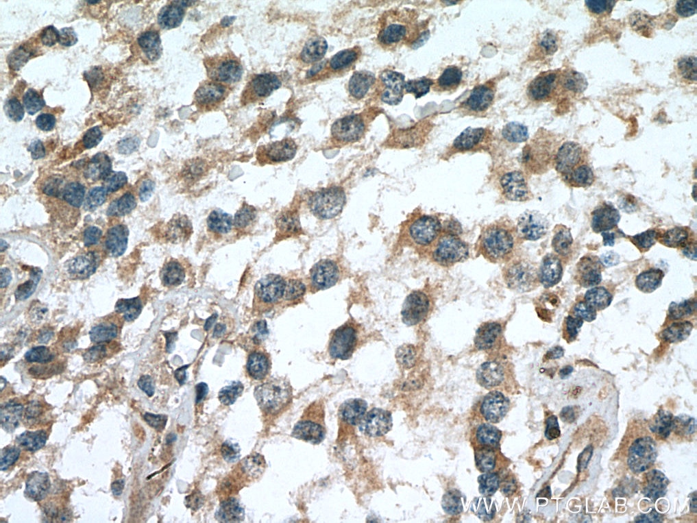Immunohistochemistry (IHC) staining of human gliomas tissue using RASGEF1A Polyclonal antibody (17121-1-AP)