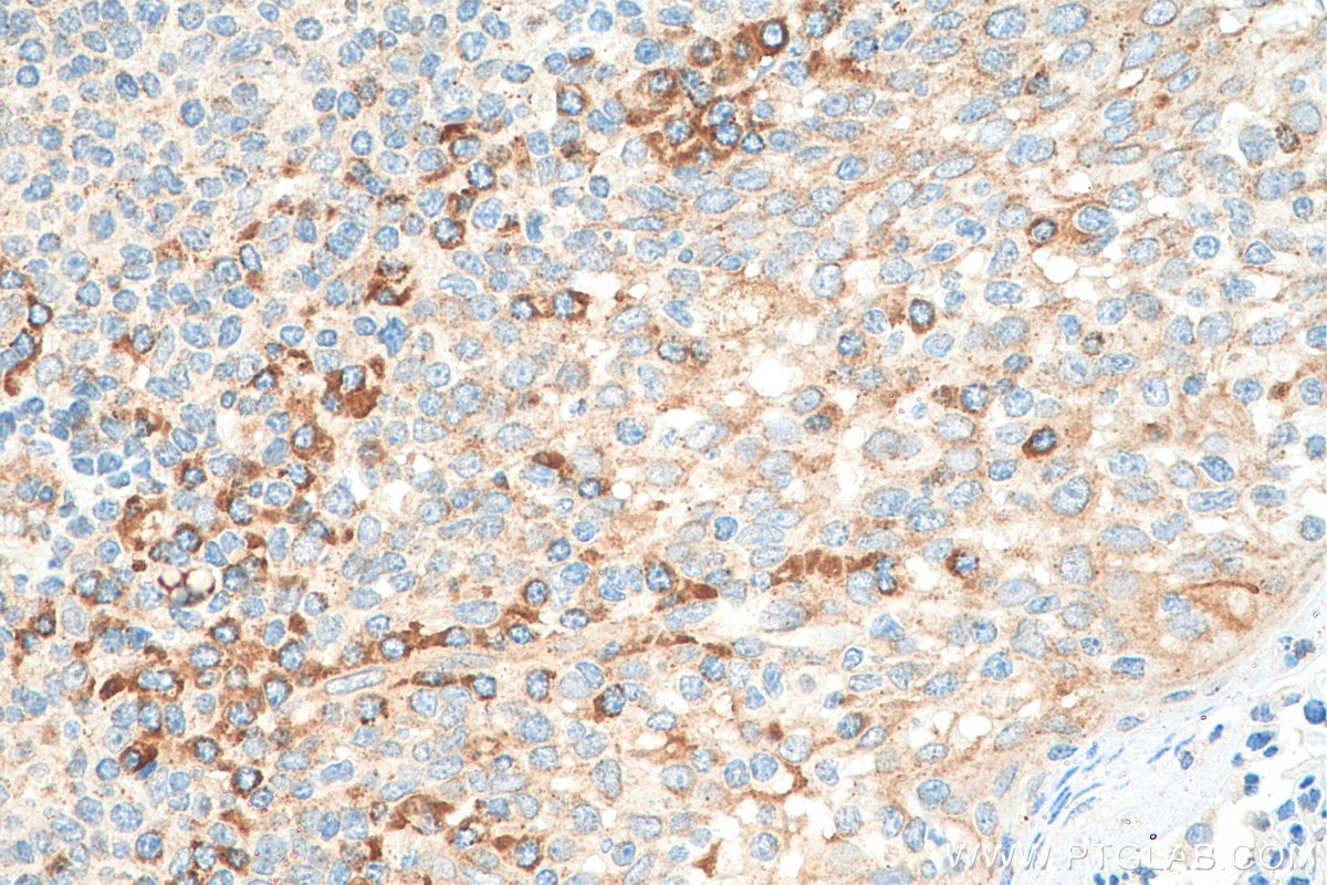Immunohistochemistry (IHC) staining of human tonsillitis tissue using RASGRF2 Polyclonal antibody (26788-1-AP)
