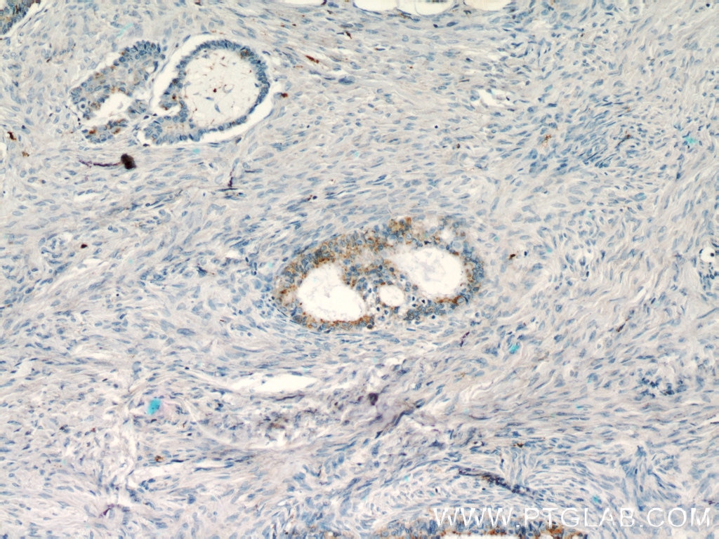 Immunohistochemistry (IHC) staining of human ovary tumor tissue using RASGRP3 Polyclonal antibody (13162-1-AP)