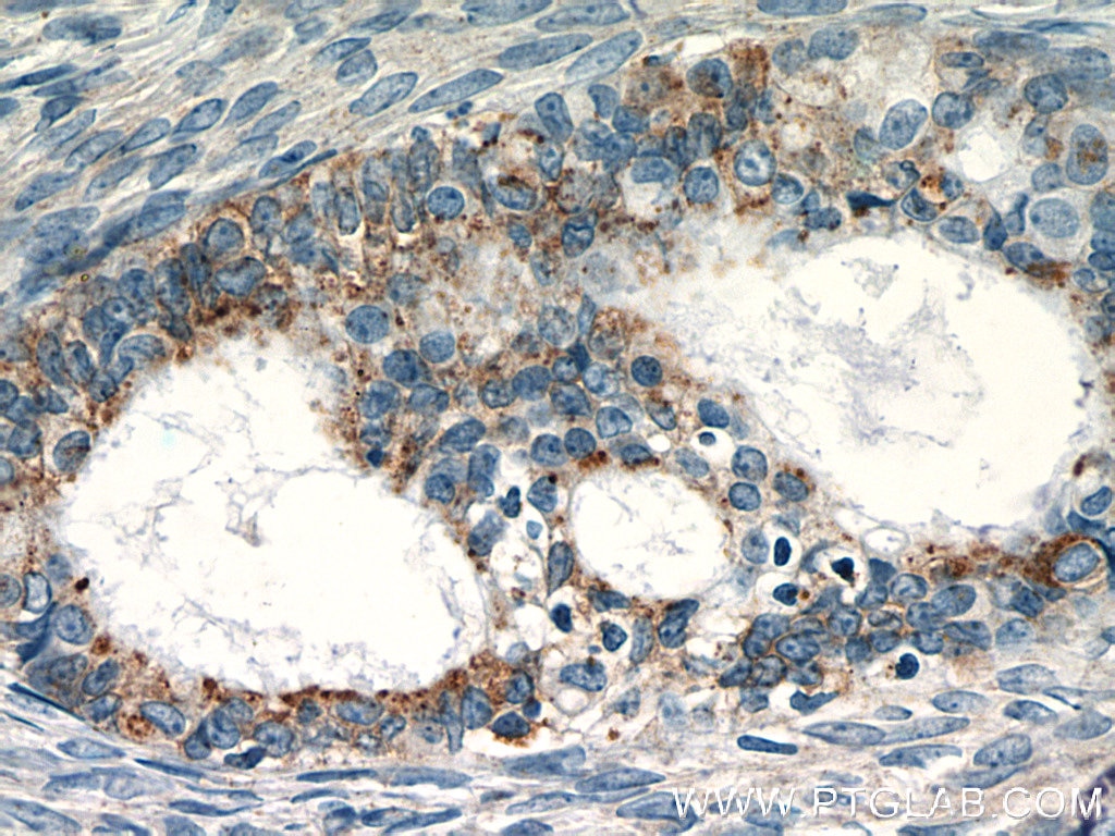 IHC staining of human ovary tumor using 13162-1-AP