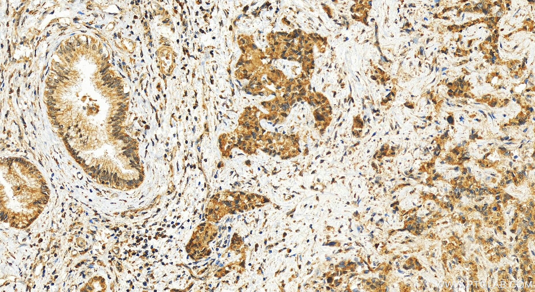 Immunohistochemistry (IHC) staining of human intrahepatic cholangiocarcinoma tissue using RASSF4 Polyclonal antibody (19118-1-AP)