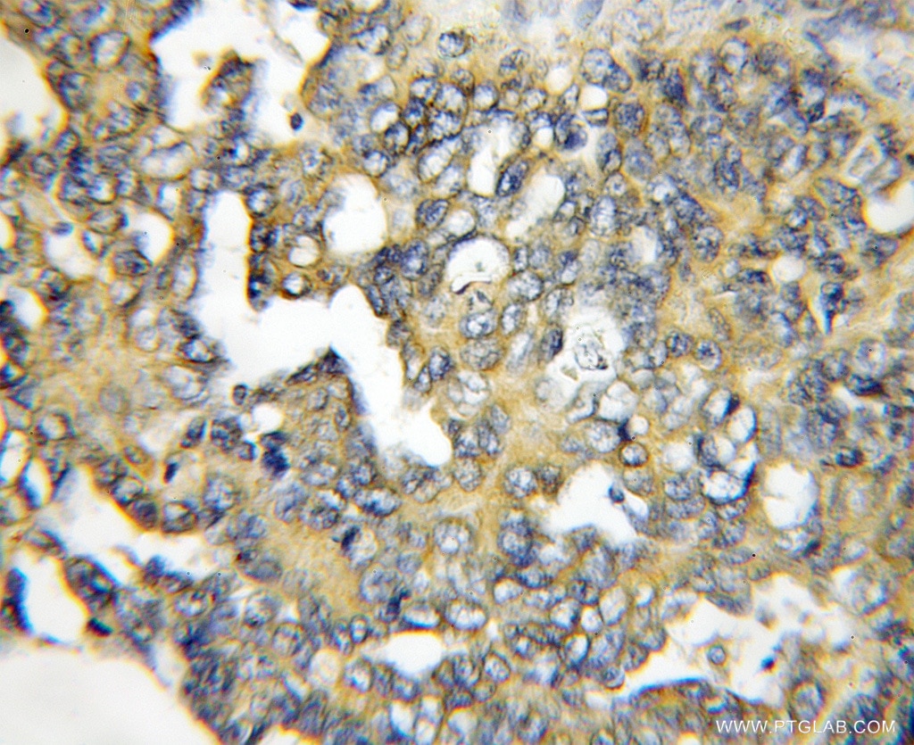 Immunohistochemistry (IHC) staining of human ovary tumor tissue using RASSF6 Polyclonal antibody (11921-1-AP)