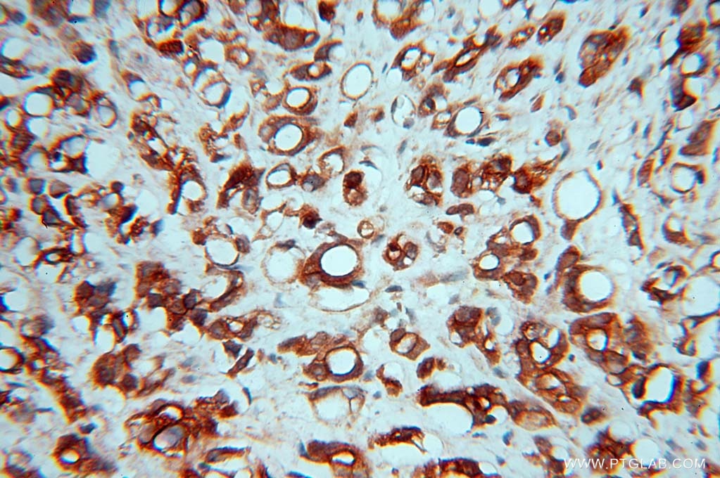 Immunohistochemistry (IHC) staining of human prostate cancer tissue using RASSF6 Polyclonal antibody (11921-1-AP)