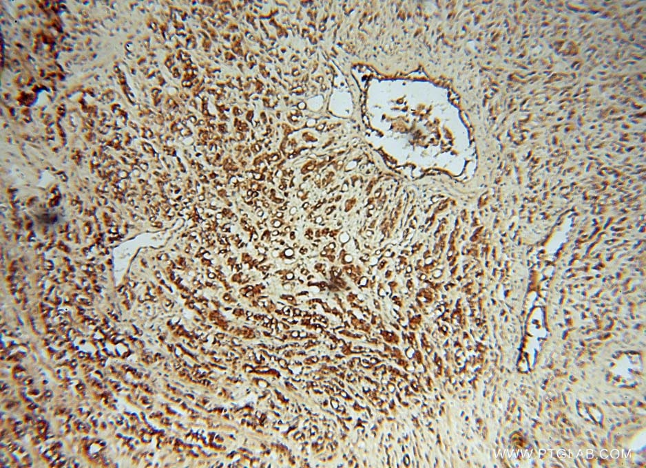 Immunohistochemistry (IHC) staining of human prostate cancer tissue using RASSF6 Polyclonal antibody (11921-1-AP)