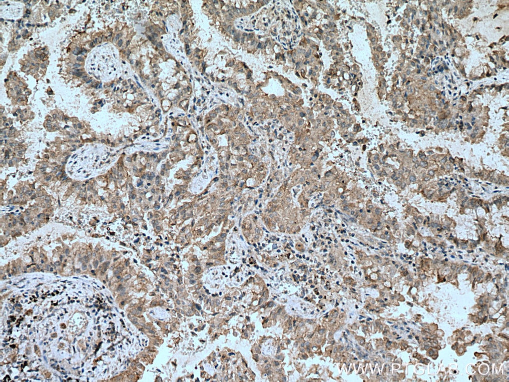 IHC staining of human lung cancer using 21753-1-AP