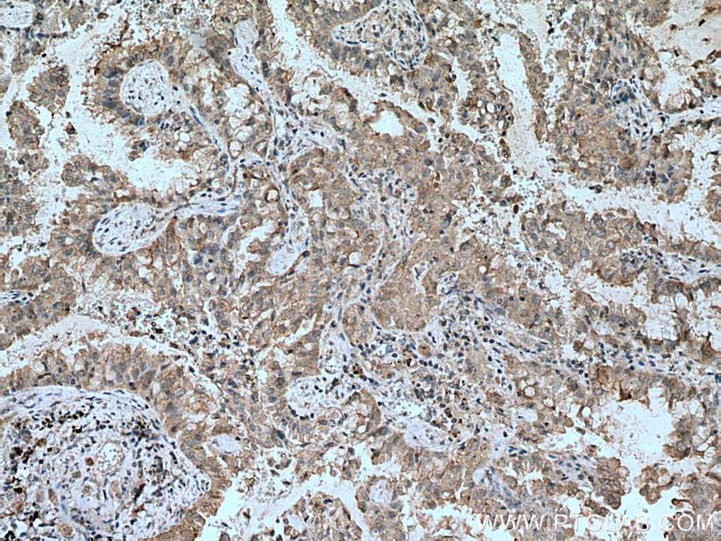 Immunohistochemistry (IHC) staining of human lung cancer tissue using RASSF7 Polyclonal antibody (21753-1-AP)