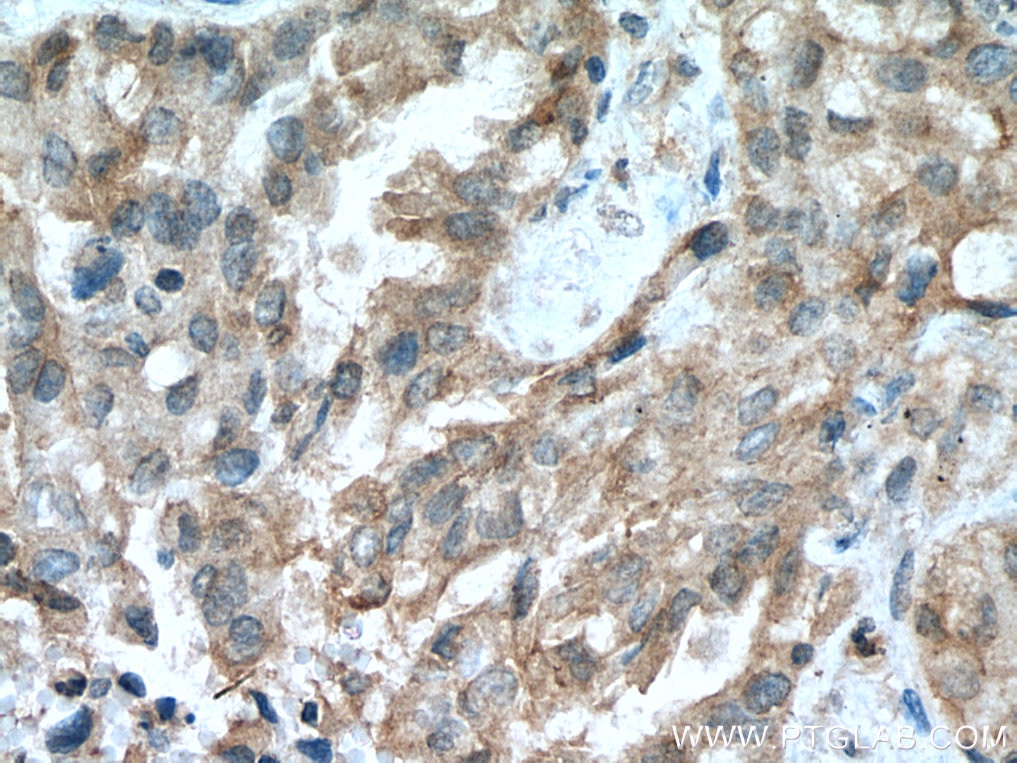 Immunohistochemistry (IHC) staining of human lung cancer tissue using RASSF7 Polyclonal antibody (21753-1-AP)