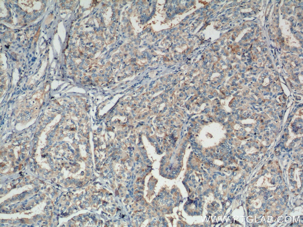 Immunohistochemistry (IHC) staining of human thyroid cancer tissue using RASSF7 Polyclonal antibody (21753-1-AP)