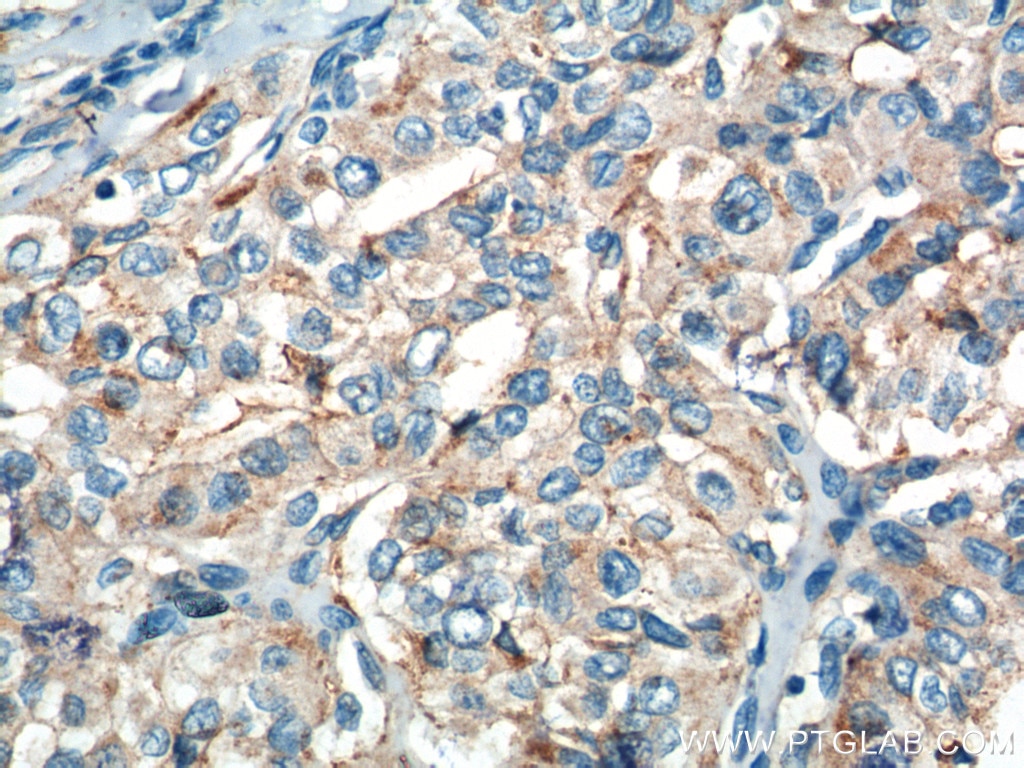 Immunohistochemistry (IHC) staining of human thyroid cancer tissue using RASSF7 Polyclonal antibody (21753-1-AP)