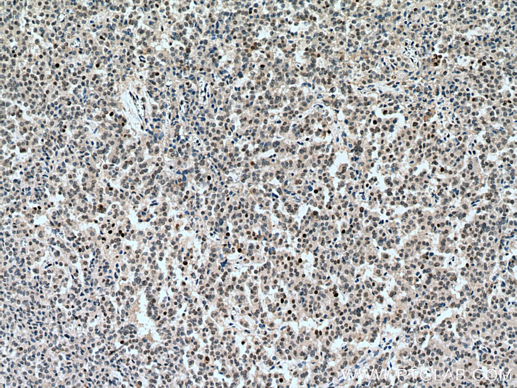 Immunohistochemistry (IHC) staining of Insulinoma tissue using RB1 Monoclonal antibody (67521-1-Ig)