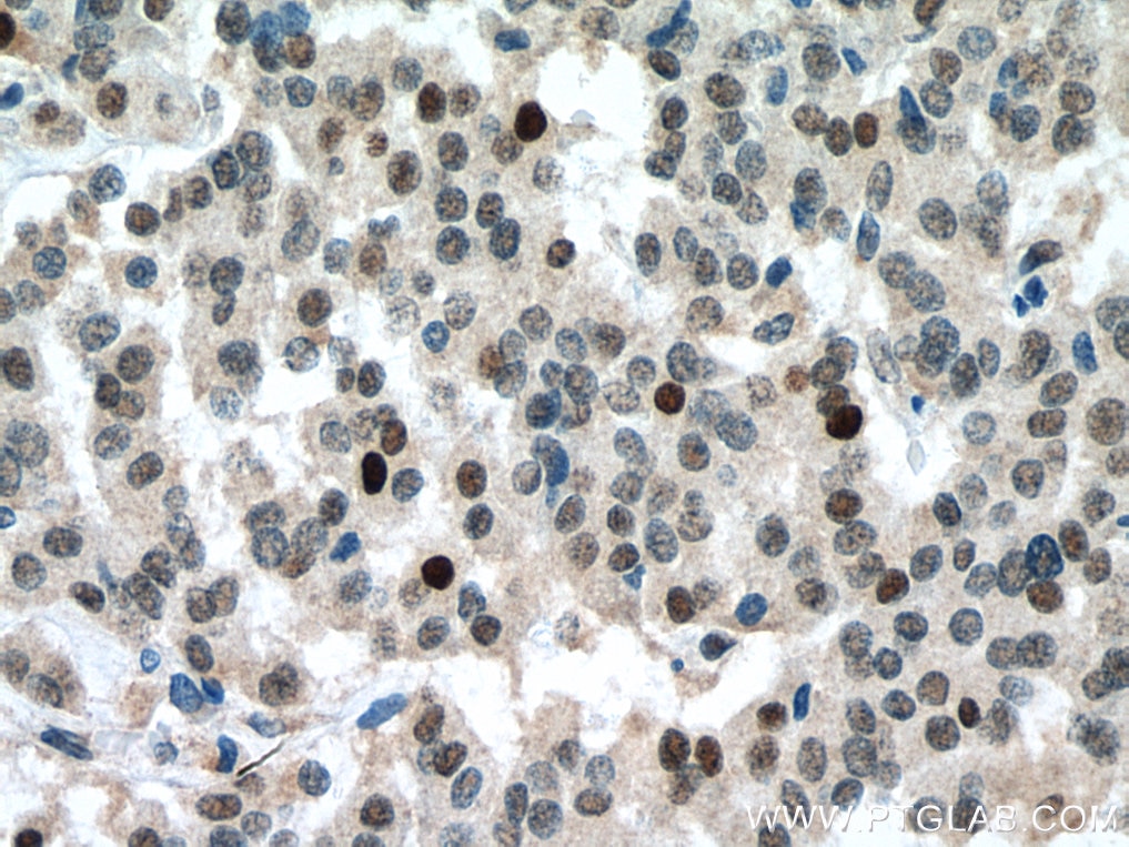 Immunohistochemistry (IHC) staining of Insulinoma tissue using RB1 Monoclonal antibody (67521-1-Ig)