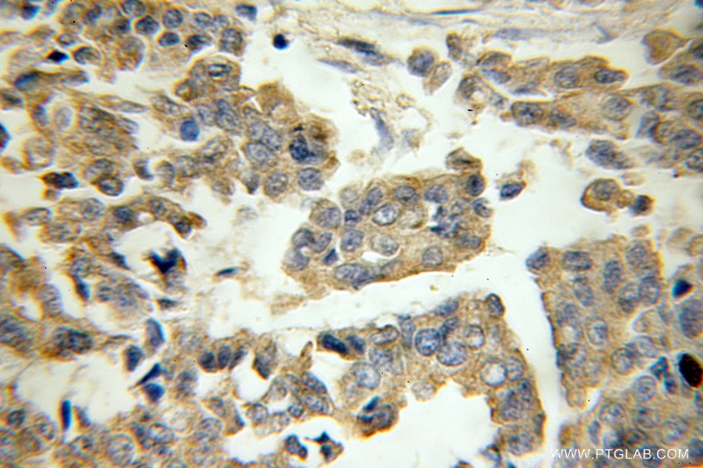 IHC staining of human breast cancer using 10043-2-AP