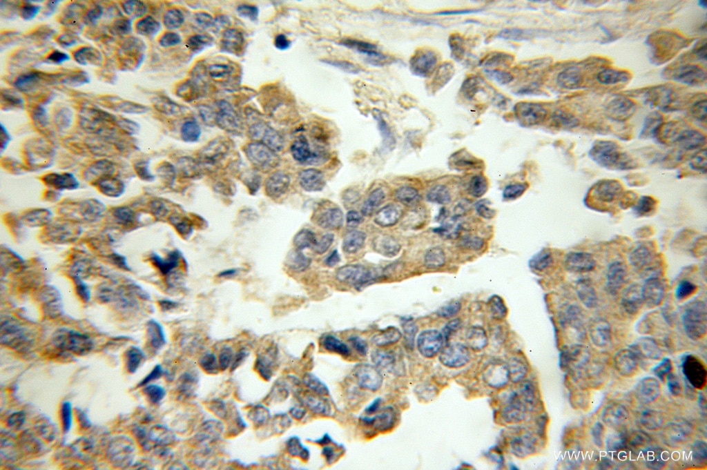 Immunohistochemistry (IHC) staining of human breast cancer tissue using RB1CC1 Polyclonal antibody (10043-2-AP)