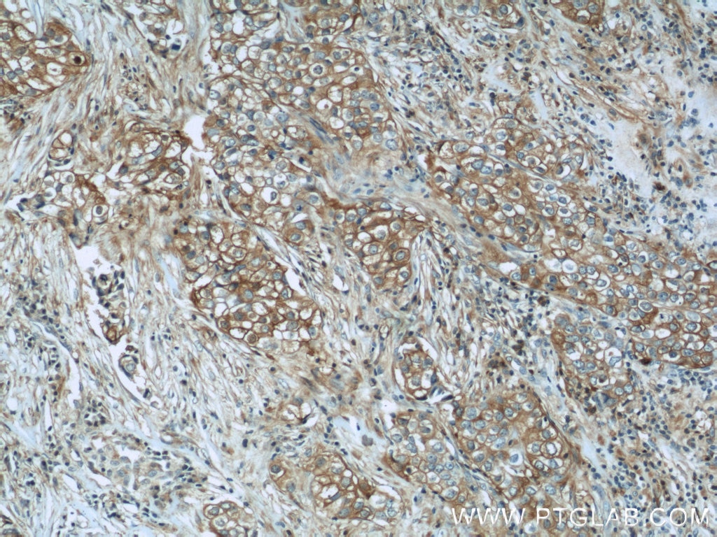 Immunohistochemistry (IHC) staining of human breast cancer tissue using RB1CC1 Polyclonal antibody (10043-2-AP)