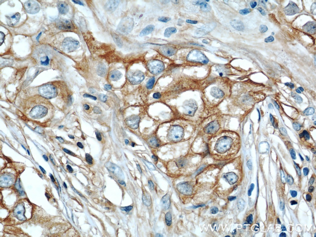 IHC staining of human breast cancer using 10043-2-AP