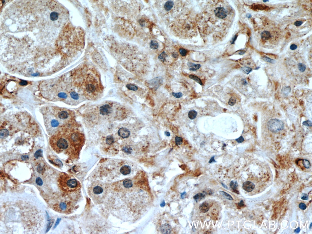 Immunohistochemistry (IHC) staining of human breast cancer tissue using RB1CC1 Polyclonal antibody (10069-1-AP)