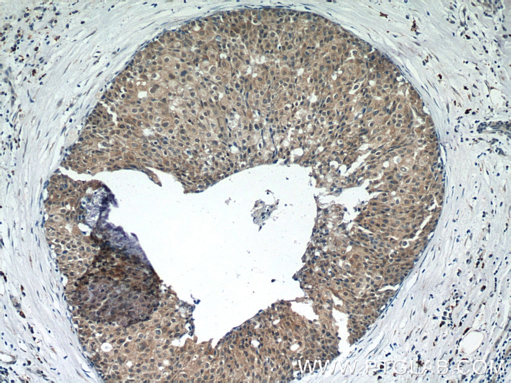 IHC staining of human breast cancer using 17250-1-AP