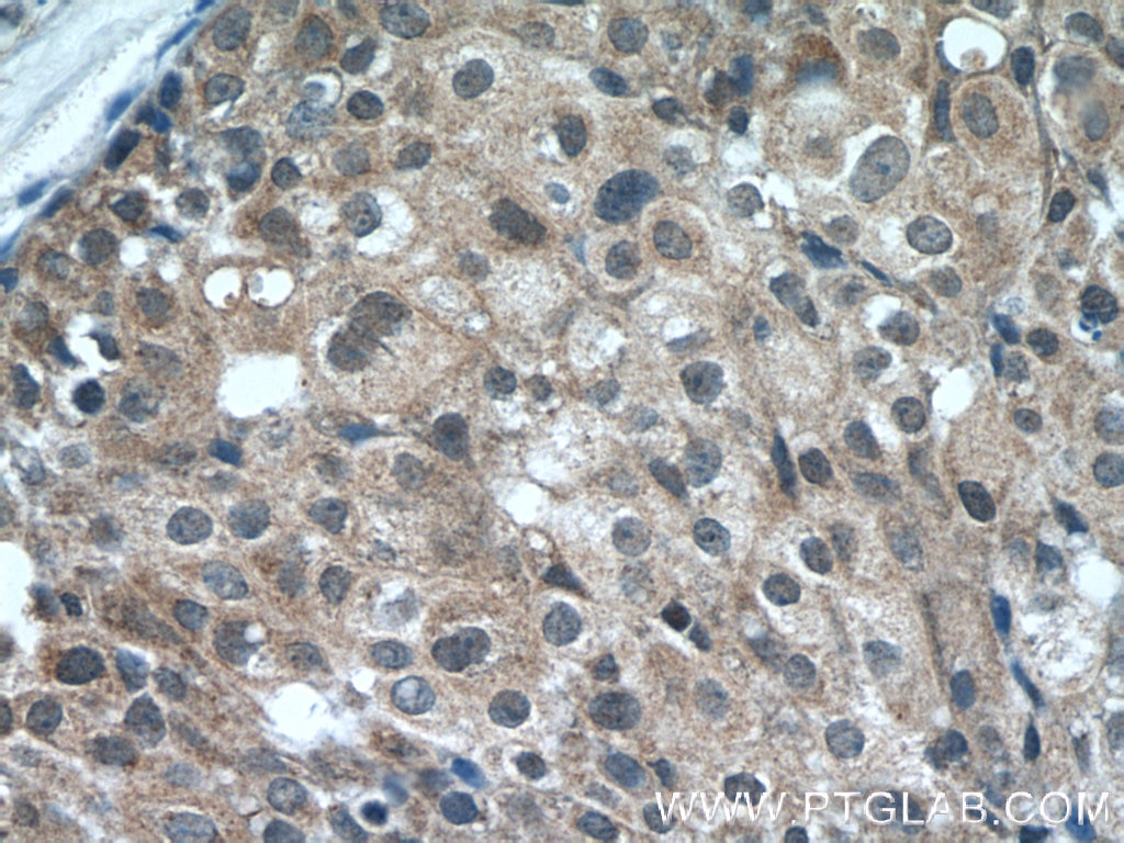 Immunohistochemistry (IHC) staining of human breast cancer tissue using RB1CC1 Polyclonal antibody (17250-1-AP)
