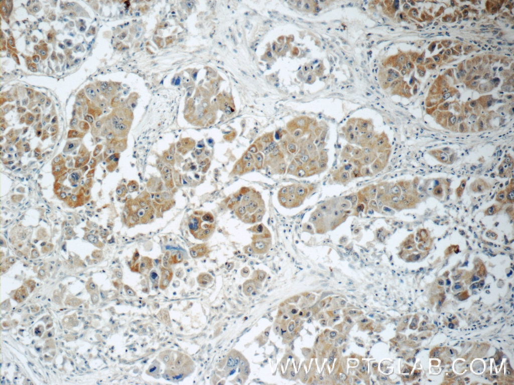 Immunohistochemistry (IHC) staining of human liver cancer tissue using RB1CC1 Polyclonal antibody (17250-1-AP)