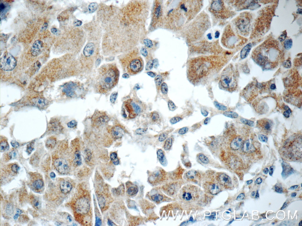 Immunohistochemistry (IHC) staining of human liver cancer tissue using RB1CC1 Polyclonal antibody (17250-1-AP)