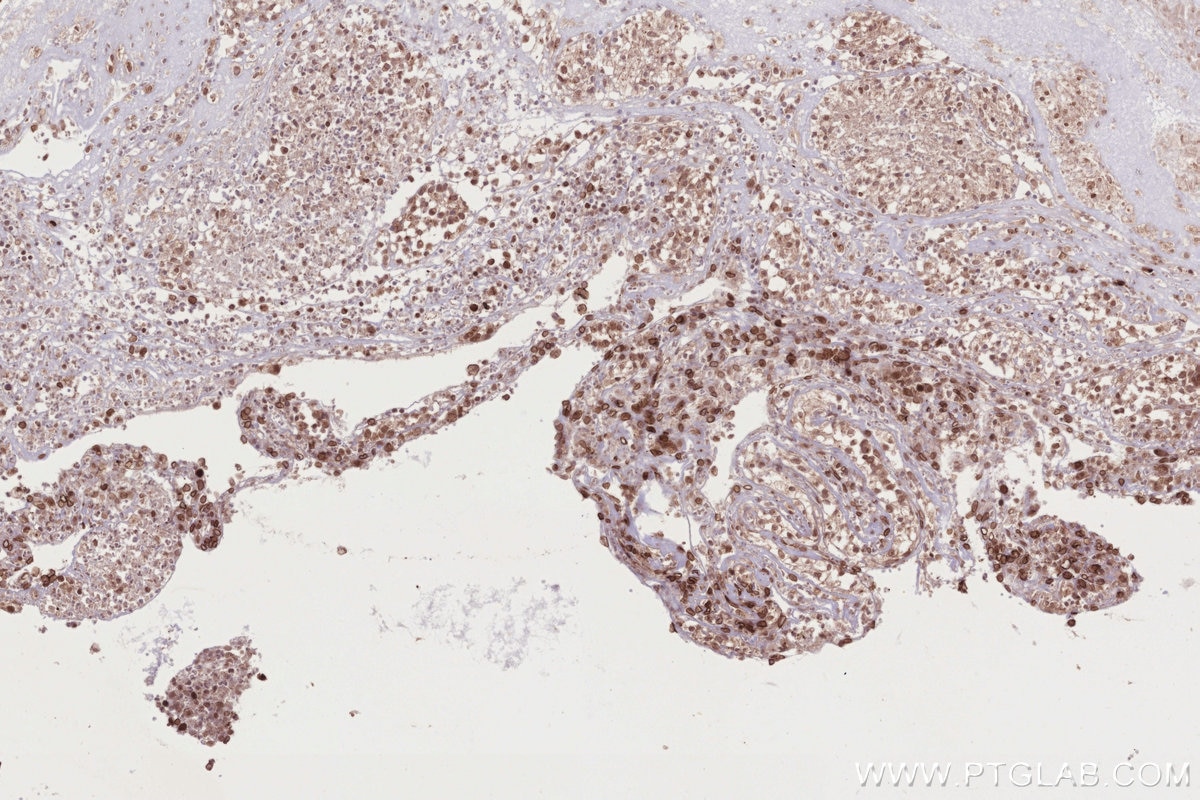 IHC staining of human ovary cancer using 84757-3-RR Immunohistochemistry (IHC) staining of human ovary cancer tissue using RB1CC1 Recombinant monoclonal antibody (84757-3-RR)