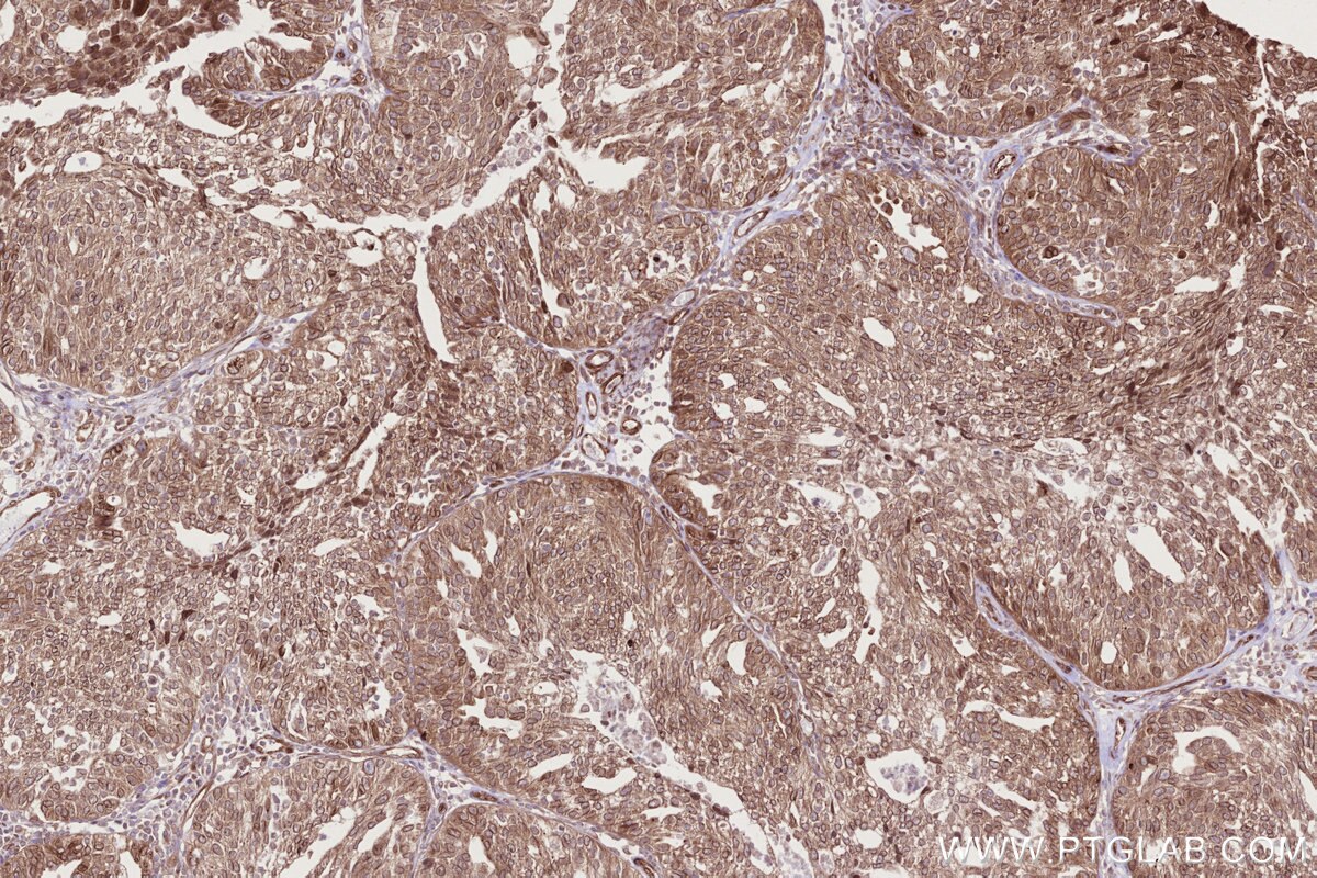 IHC staining of human ovary cancer using 84757-3-RR Immunohistochemistry (IHC) staining of human ovary cancer tissue using RB1CC1 Recombinant monoclonal antibody (84757-3-RR)
