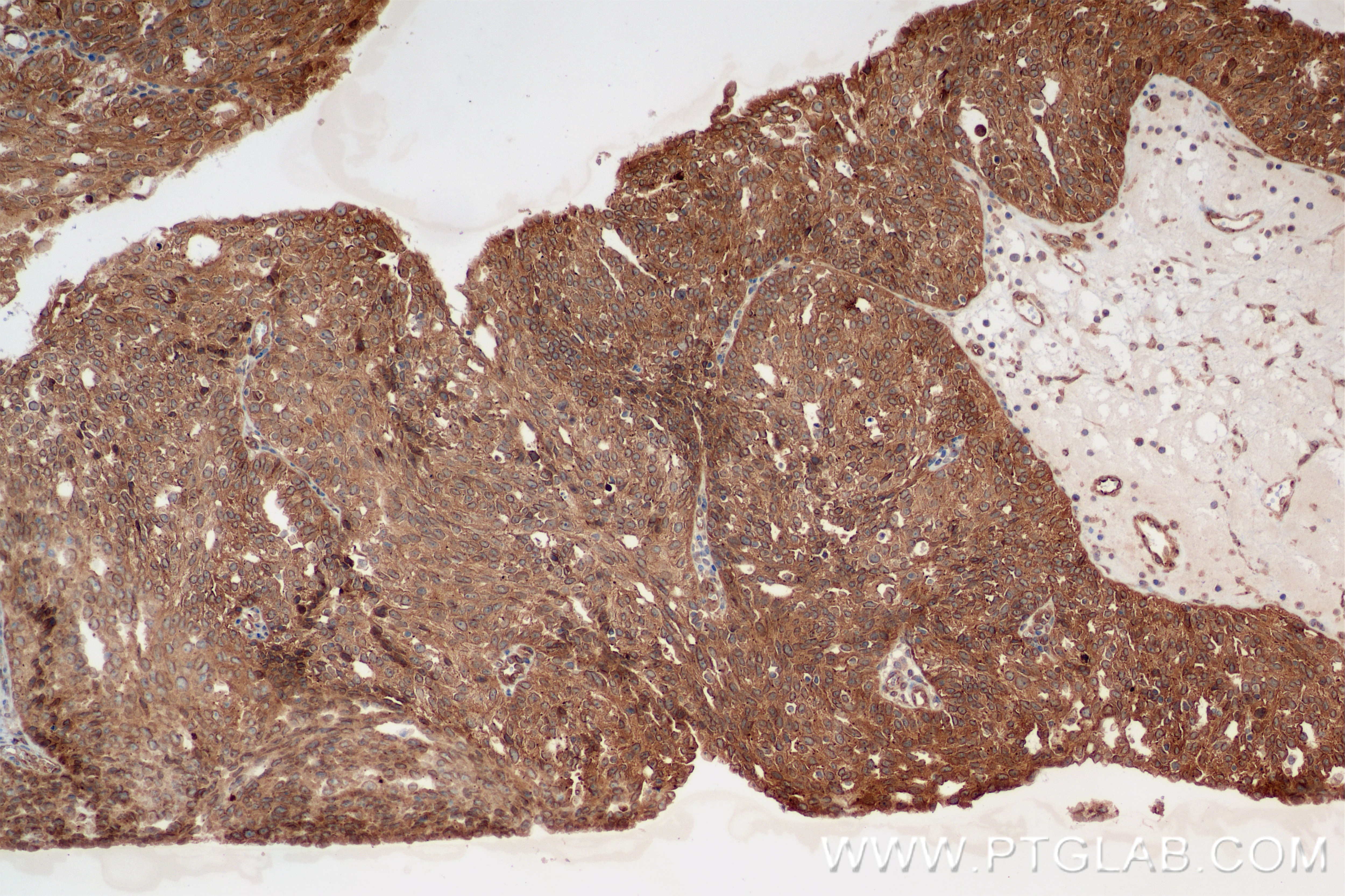 Immunohistochemistry (IHC) staining of human ovary cancer tissue using RB1CC1 Recombinant antibody (84757-3-RR)