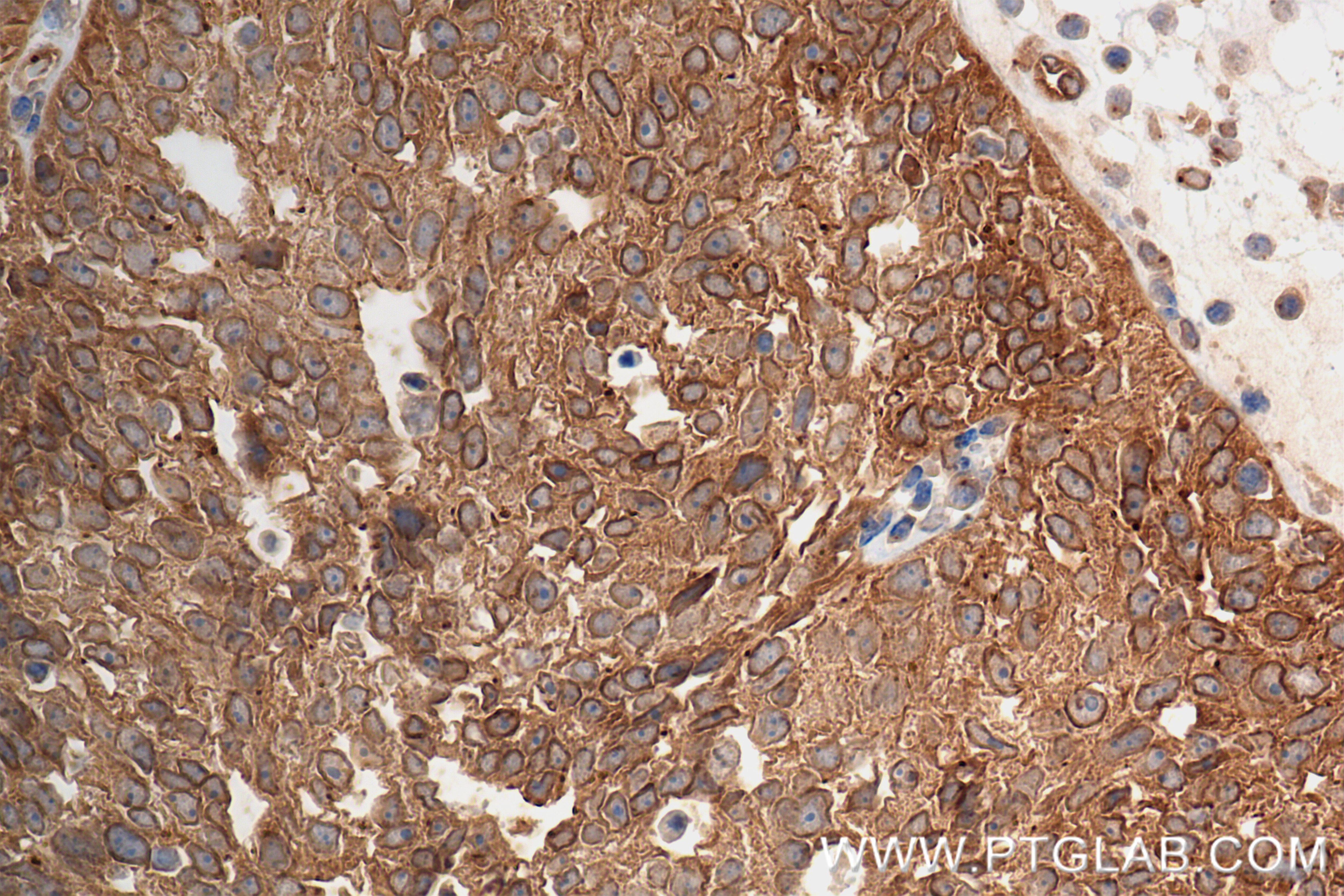 Immunohistochemistry (IHC) staining of human ovary cancer tissue using RB1CC1 Recombinant antibody (84757-3-RR)