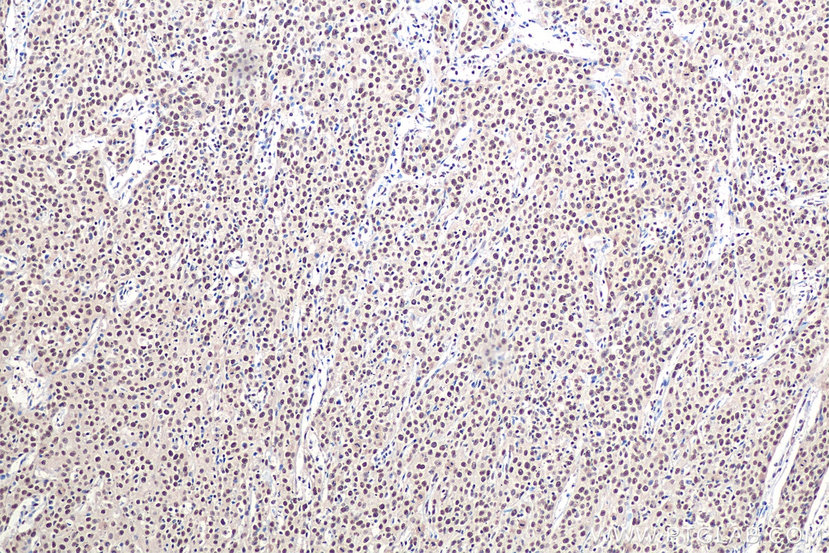 Immunohistochemistry (IHC) staining of human cervical cancer tissue using RBAP48 Polyclonal antibody (20364-1-AP)